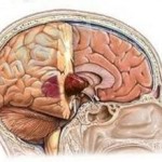 Доброкачественная опухоль мозга: симптомы, лечение, виды