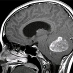 Опухоль мозжечка мозга: симптомы и признаки