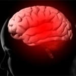 Глиосаркома головного мозга: лечение, прогноз