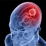 Воспаление коры и сосудов головного мозга: симптомы и лечение