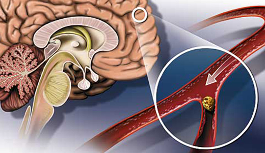 Атеросклероз артерий мозга