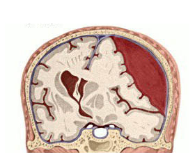 Средство для рассасывания гематом в мозге