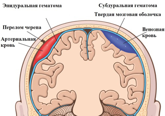 Гематома мозга