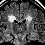 Демиелинизация головного мозга: симптомы, лечение