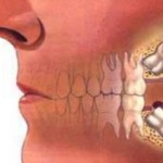 Что делать, если после удаления зуба болит голова?