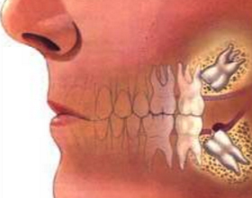 Что делать, если после удаления зуба болит голова