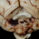 Арахноидальная киста головного мозга: причины и лечение