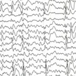 Роландическая эпилепсия: что это, лечить или не лечить