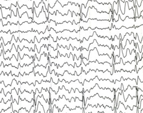Роландическая эпилепсия: что это, лечить или не лечить