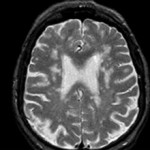 Лейкоареоз головного мозга: что это, причины и лечение