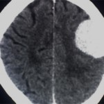 Менингиома головного мозга: последствия, прогнозы, лечение
