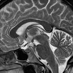 Что такое МРТ головного мозга (и как проводится)