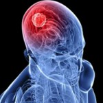 Неоперапельная опухоль головного мозга — что это, симптомы и лечение