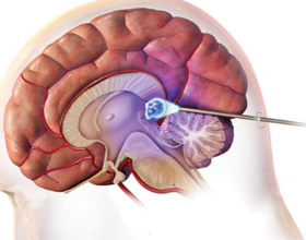 Пинеальная киста головного мозга: симптомы, лечение