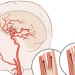 Стеноз сосудов головного мозга: что это, причины, лечение