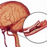 Тромбоз сосудов головного мозга: симптомы и что делать