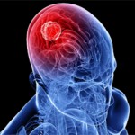 Рак головного мозга: симптомы, признаки, прогнозы