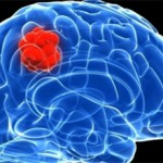 Глиобластома головного мозга: причины, симптомы, лечение