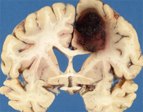 Кровоизлияние в мозг: симптомы и лечение