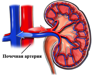 Реноваскулярная гипертензия